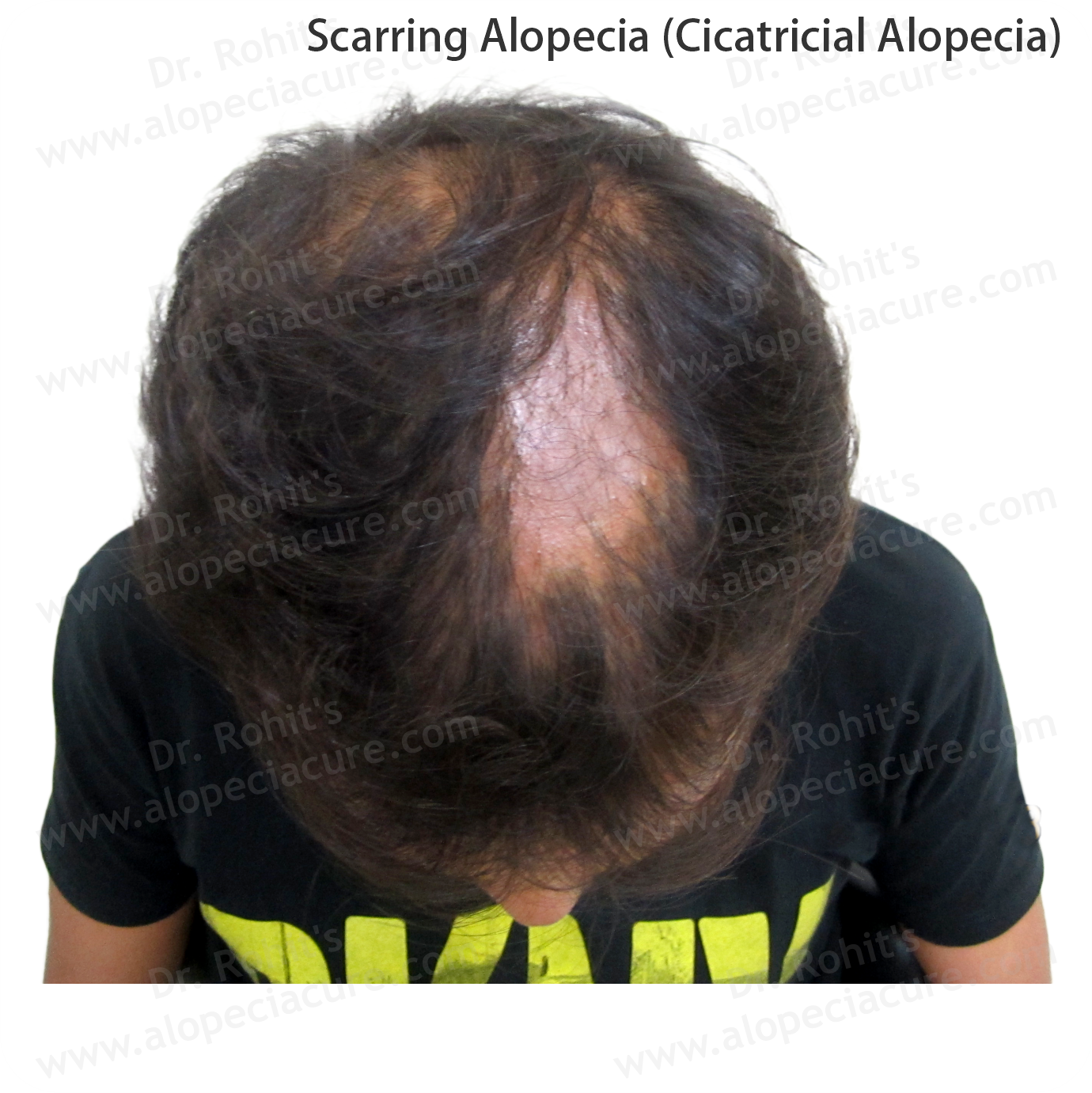 Alopecia Result